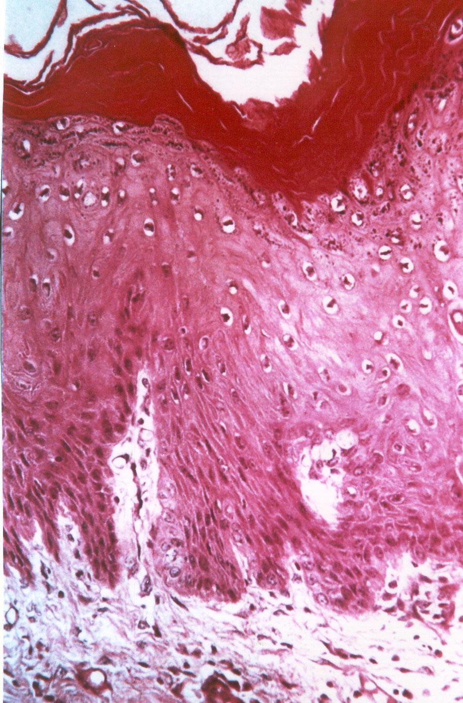 Squamous cell papilloma