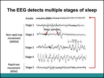 Slide 13 Ask the students can anyone guess what is happening during sleep stage 5 that would cause the brain to have an EEG that is similar to the awake brain?