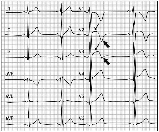 EARLY REPOLARIZATION PATTERN Early repolarization pattern in a healthy black athlete