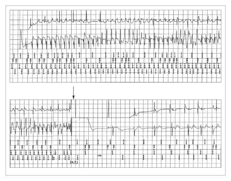 Intracardiac Electrogram Showing the Mechanism of Sudden Death in