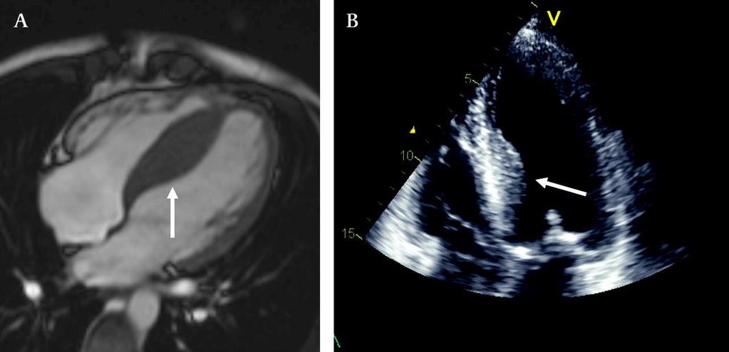 Septal hypertrophy (arrow) demonstrated on four chamber MRI (A) and on four chamber two dimensional (2D)