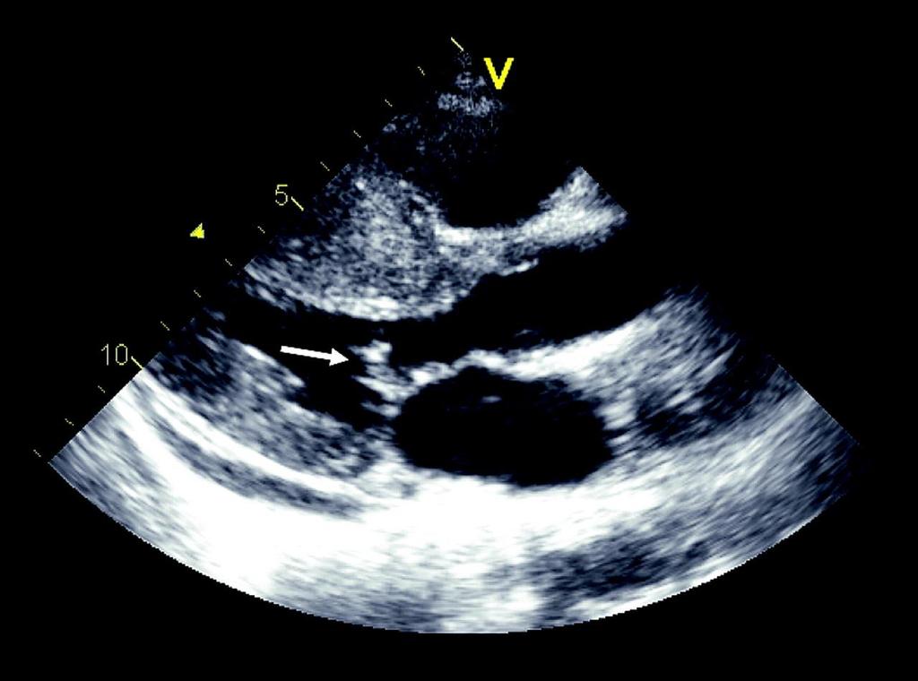 Systolic anterior movement (SAM; arrow) of the anterior mitral valve leaflet in a patient with hypertrophic obstructive cardiomyopathy demonstrated with 2D