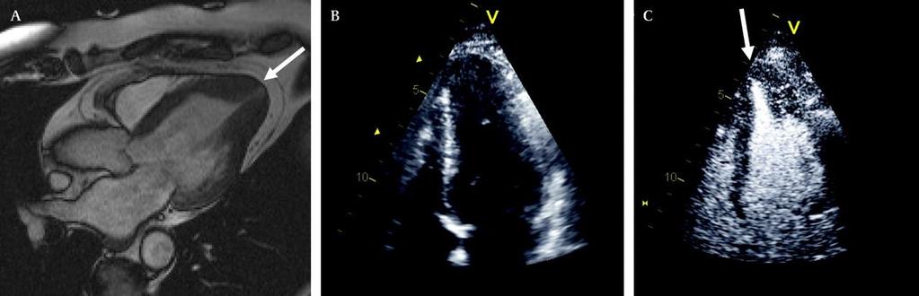 Apical hypertrophy (arrow) demonstrated with four chamber MRI (A) and with four chamber 2D echocardiography (B