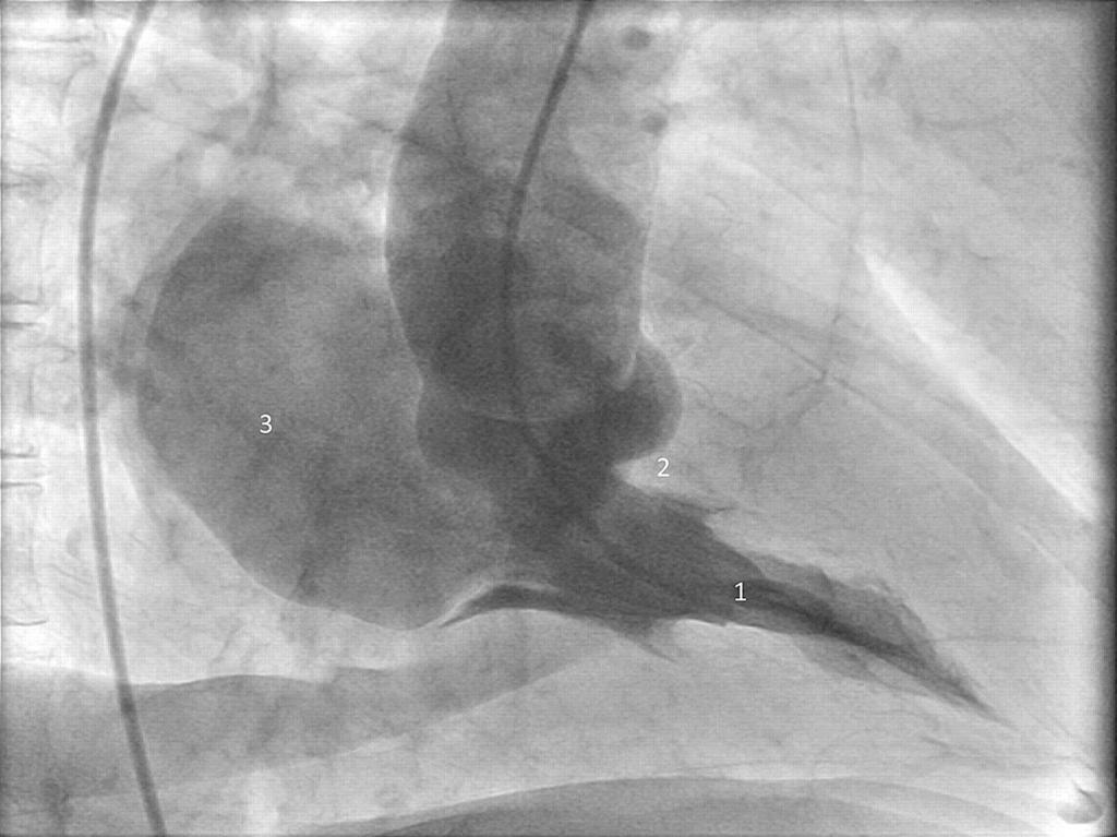 Angiogram of the left ventricle in the right oblique view.