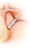 Surgical Options Malabsorptive biliopancreatic diversion with duodenal switch Restrictive adjustable gastric banding