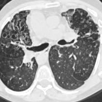 Morphology: Tubular Varicoid Cystic Morphology is indicative of severity, but rarely helpful in diagnosis Bronchiectasis - Distribution Distribution of abnormalities can help narrow differential