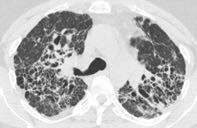 Sarcoidosis 40-year-old man with