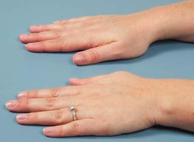 in turn, making sure that the fingers not involved in the exercise remain flat on the table Exercise 2 This exercise helps to prevent the fingers from moving sideways away from the thumb (ulnar