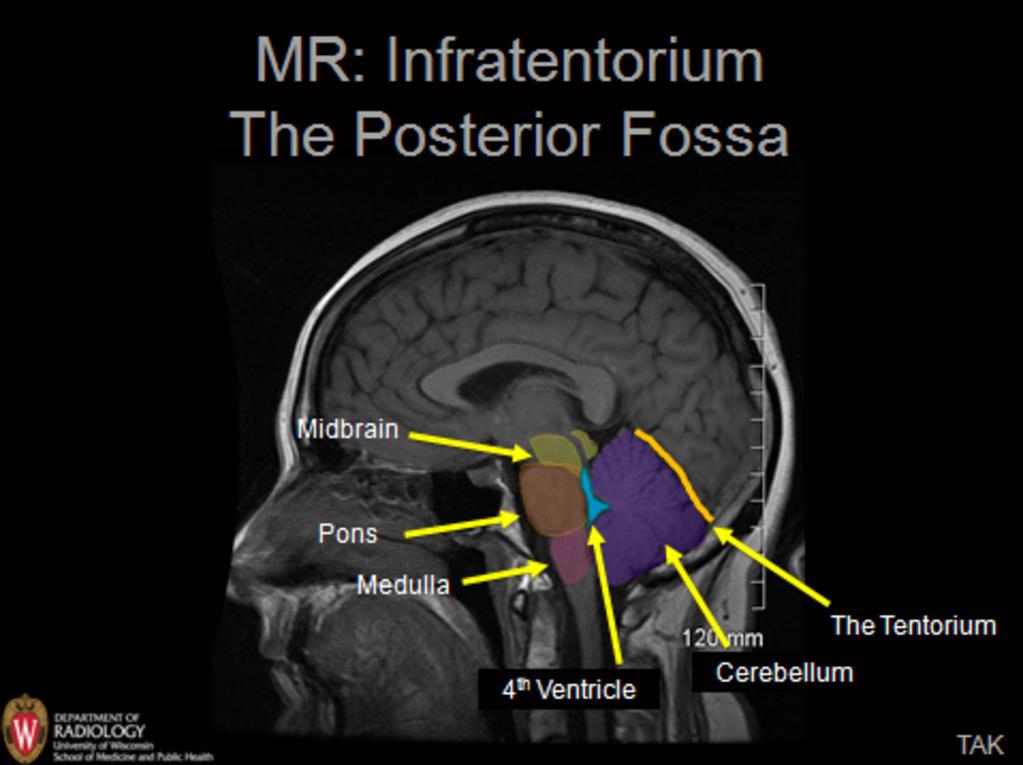 Images for this section: Fig. 1: Sagittal T1WI showing contents of the posterior fossa.