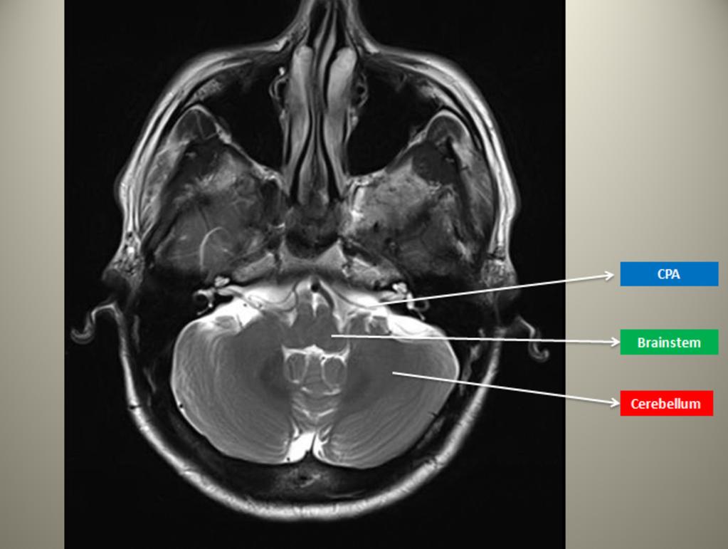 Fig. 2: Axial T2WI showing the common locations for posterior fossa brain tumors