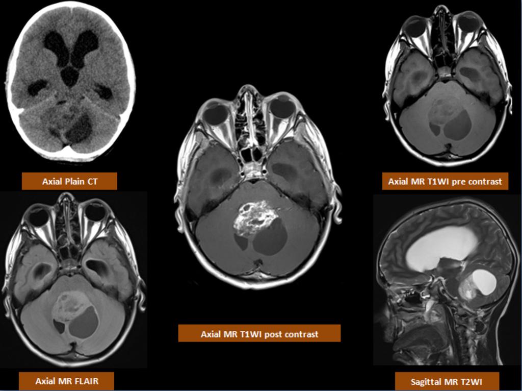 Fig. 4: Juvenile pilocytic astrocytoma (JPA); plain CT scan shows a partly solid partly cystic cerebellar lesion.