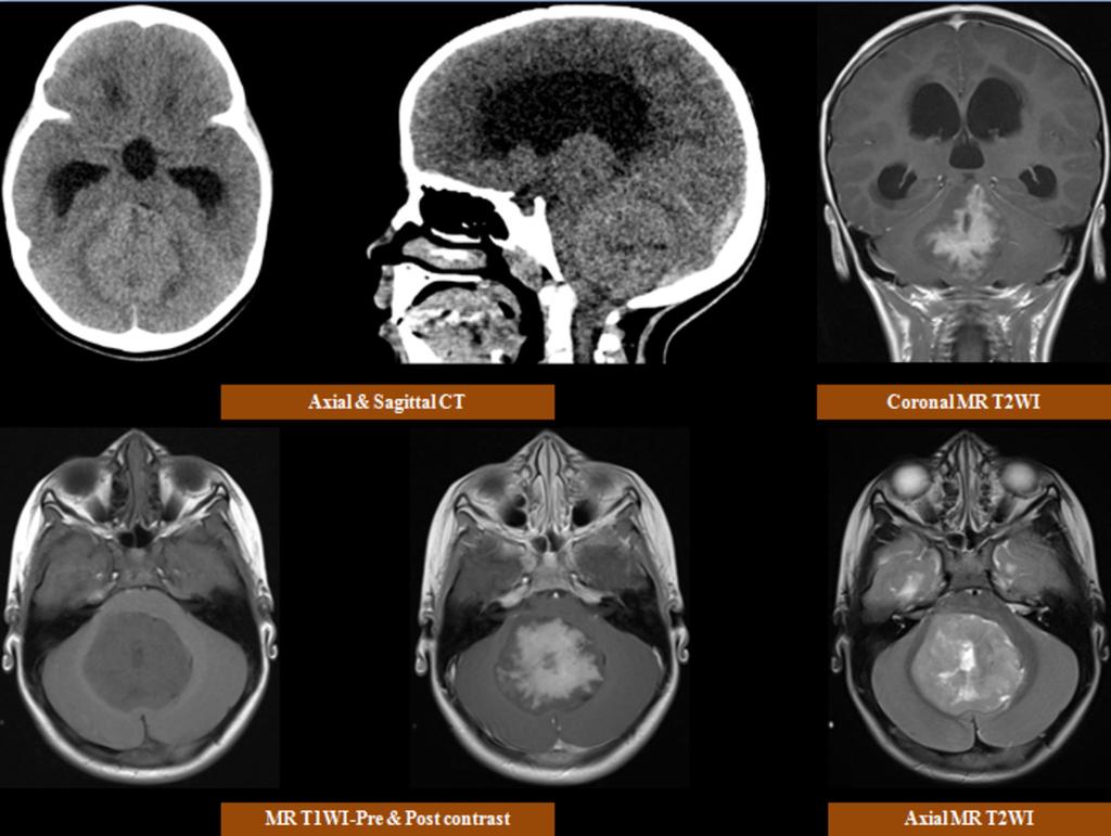 Fig. 5: Medulloblastoma; CT scan shows a midline hyperdense cerebellar lesion with secondary supra-tentorial hydrocephalus.