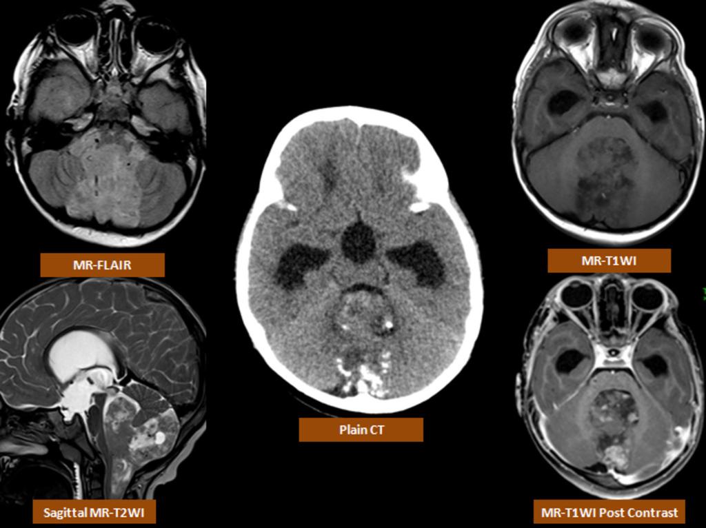 Fig. 6: Ependymoma; CT scan shows a heterogeneous 4th ventricle mass lesion with calcifications and supra-tentorial ventricular dilatation.