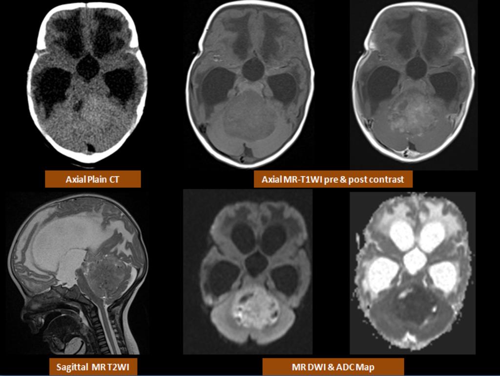 Fig. 7: Atypical Teratoid Rhabdoid Tumor (ATRT); CT scan shows a hyperdense cerebellar lesion with secondary supra-tentorial hydrocephalus.