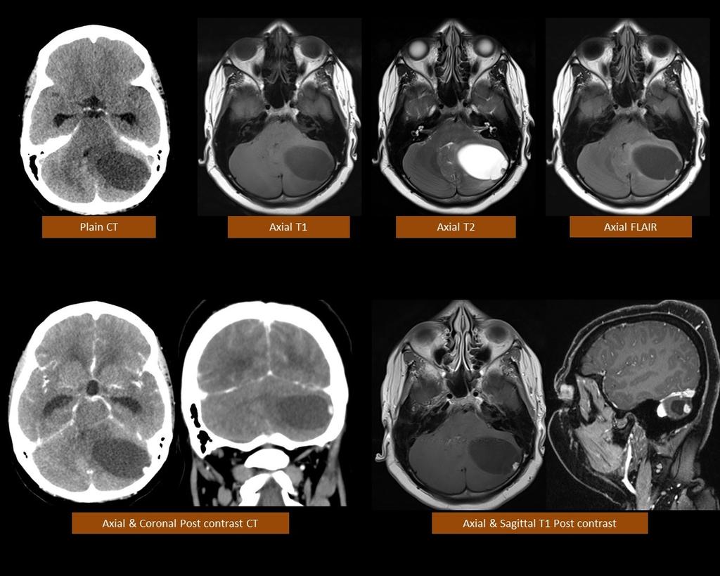 Fig. 8: Left cerebellar hemangioblastoma; axial CT scan shows a hypodense left cerebellar mass lesion with an enhancing mural nodule.