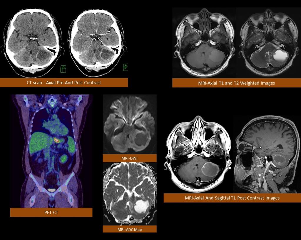 Fig. 9: Left cerebellar metastasis; known case of gastroesophageal carcinoma - axial CT scan shows a hypodense left cerebellar mass lesion with irregular peripheral post contrast enhancement.