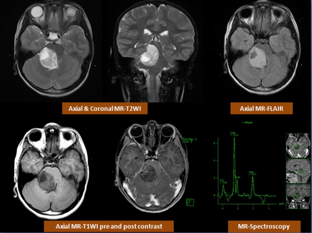 Fig. 10: Brain-stem Glioma; MRI shows an infiltrative mainly right sided brain stem lesion appearing predominantly of high signal in T2WI/FLAIR and low signal in T1WI.