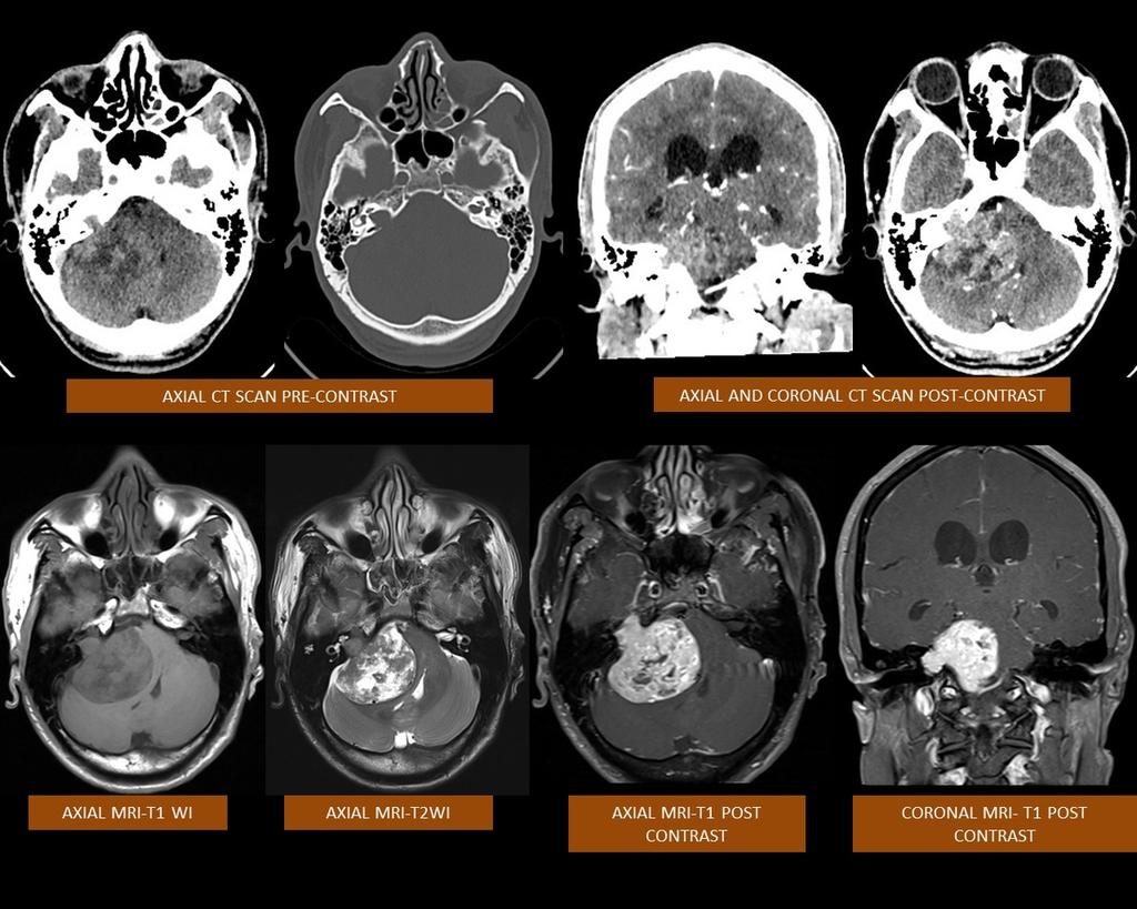 Fig. 11: Acoustic Schwannoma; axial CT scan shows a heterogeneously enhancing right CPA lesion expanding the IAC.