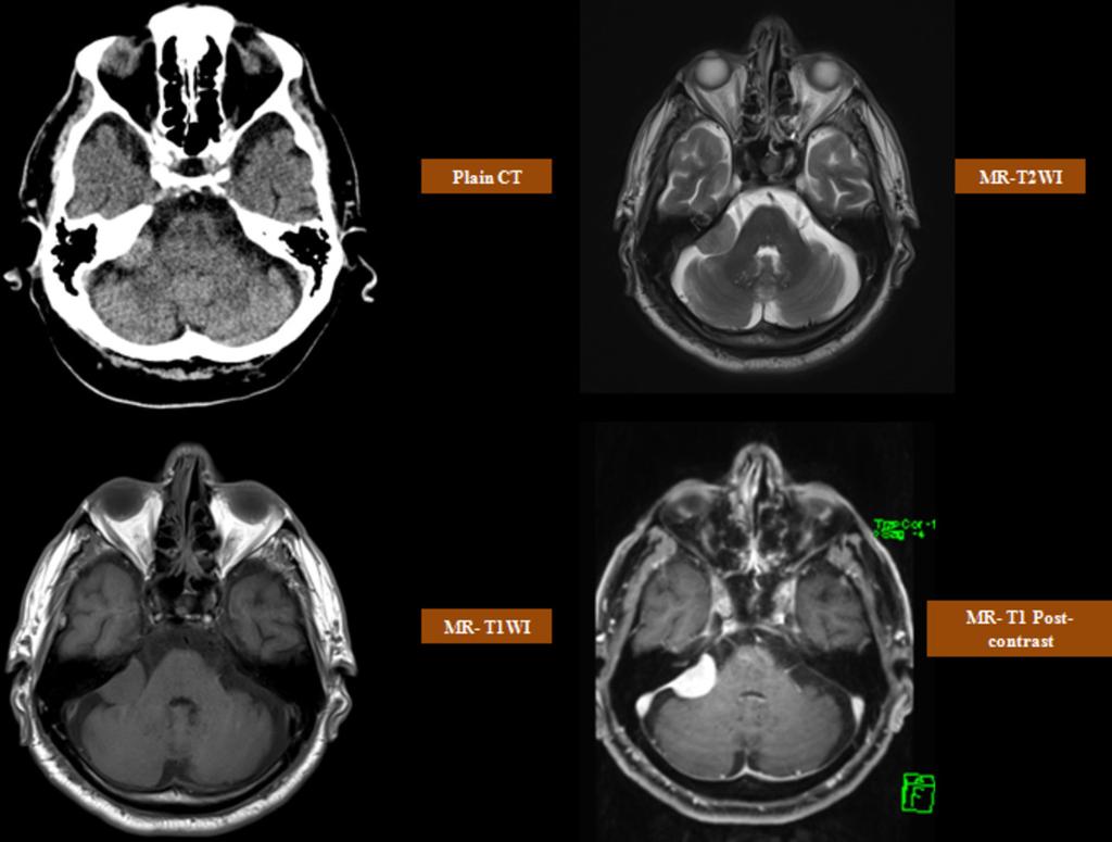 Fig. 12: CPA meningioma; CT scan shows a well defined slightly hyperdense right CP angle lesion.
