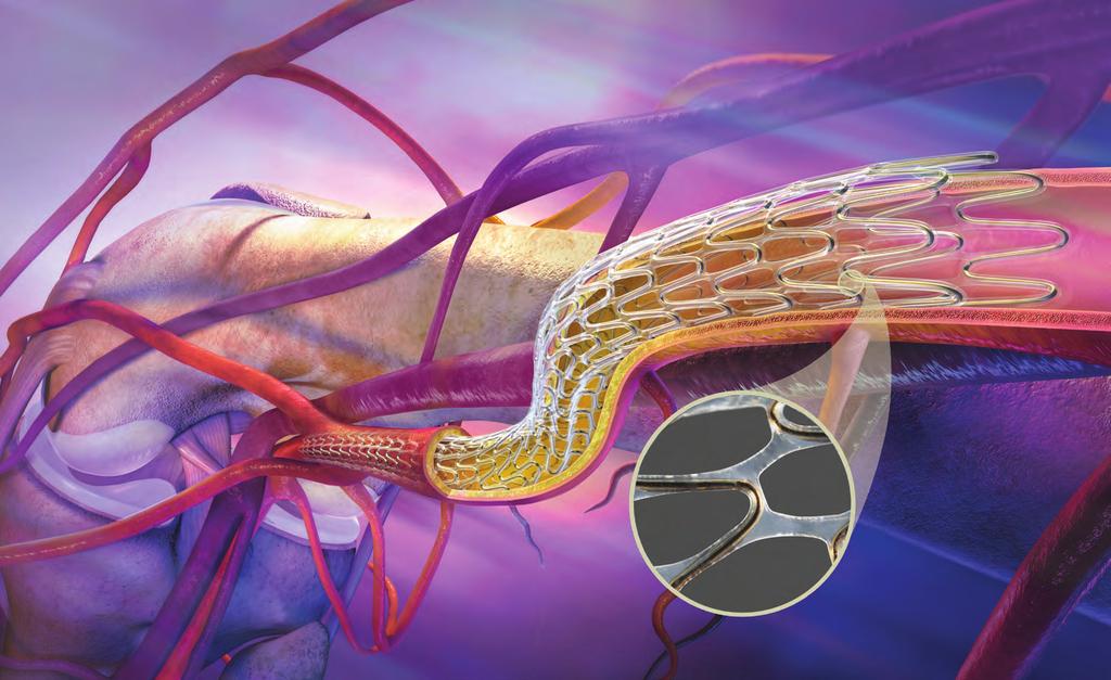 Figure 2 What is the GORE TIGRIS Vascular Stent?