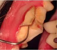 Fractured Teeth Usually due to trauma