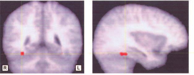 Figure 3. Older subjects contrasted with younger subjects for face versus house viewing. Data are presented on the averaged structural brain from the entire sample, warped into stereotaxic space.
