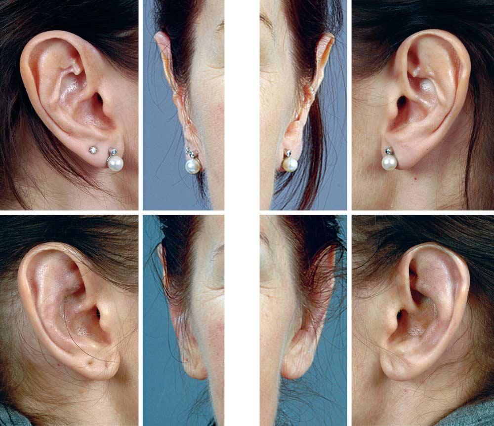 A B C D E F Figure 1. Deformity after otoplasty. A-C, Creases in the antihelix as well as a too-small concha-mastoid angle after overcorrection of protruding ears by applying cartilage incisions.