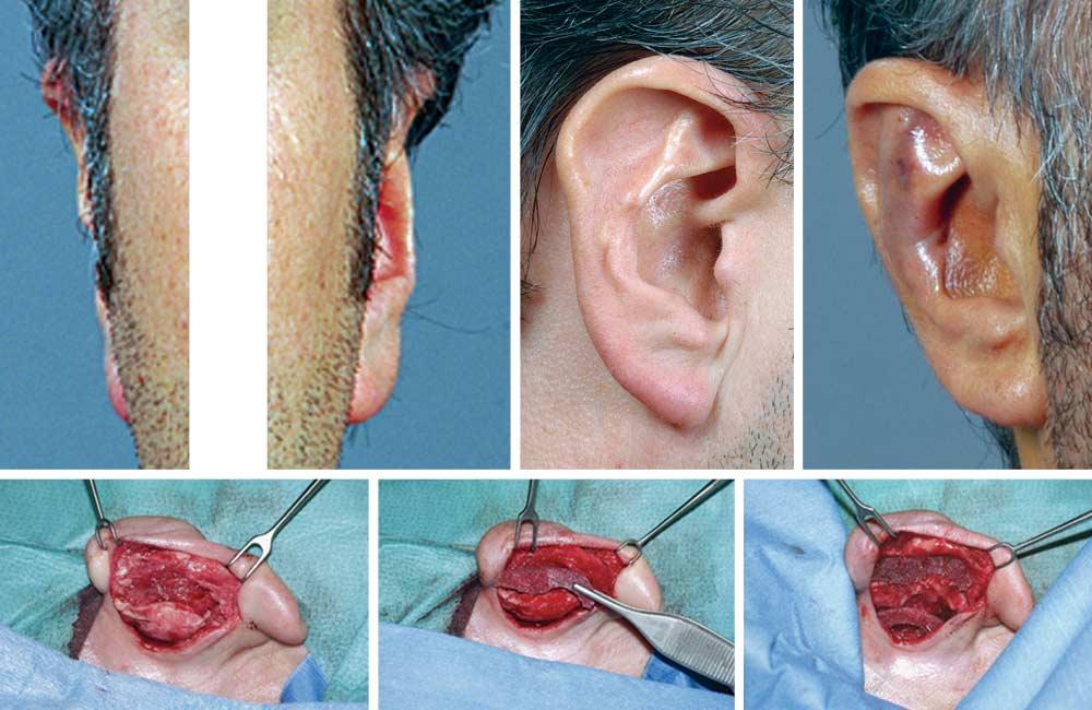 A B C D E F Figure 3. Deformity after otoplasty. A and B, Overcorrection of both ears, with an additional postoperative deformity on the right side. C, Result 5 days postoperatively.