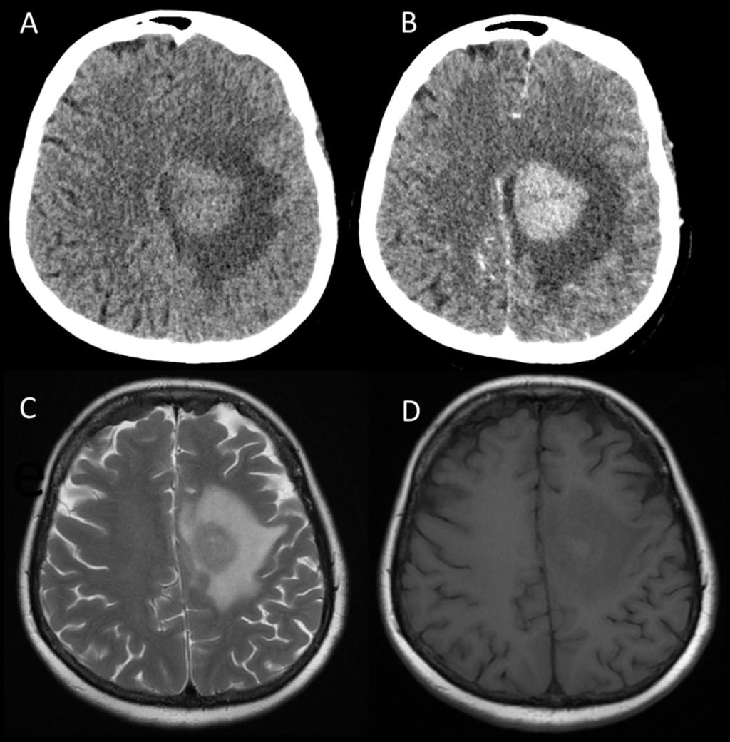 Fig. 1: Typical features of PCNSL: Noncontrast and contrast CT images (1A and 1B) shows large solitary homogeneously enhancing mass.