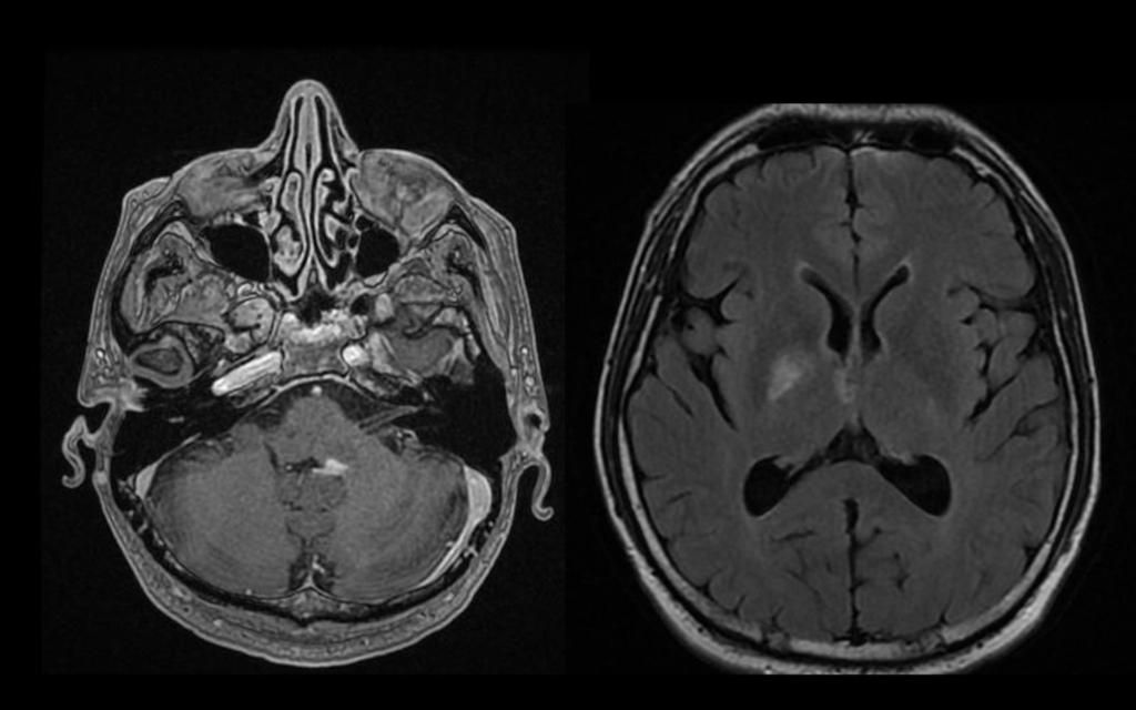 3: Axial contrast-enhanced T1-weigted MR image in patient with disseminated disease shows atypical
