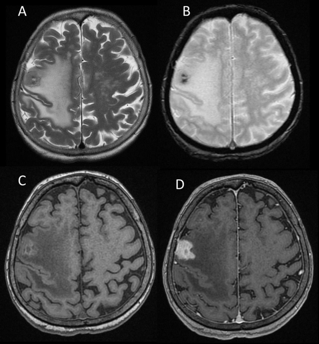 Fig. 5: T2W (6A), GRE (6B), T1W pre- and postcontrast images (6C and 6D) reveals space occupying lesion, relatively homogenous except in small central area which is necrotic.