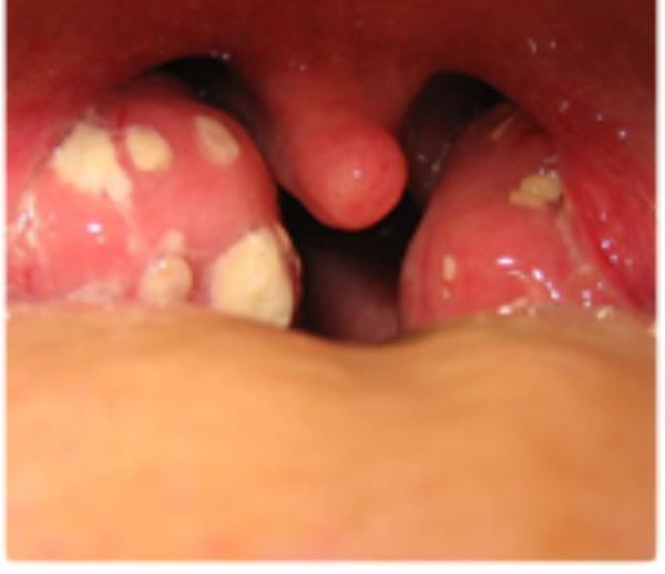 These are the calcification product of food debris caught in the pores of the tonsils.