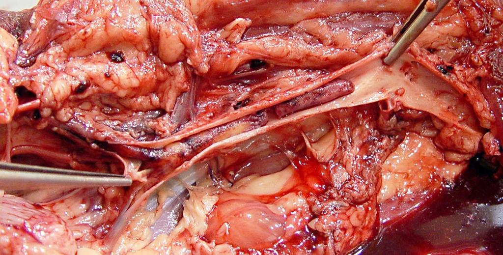 THROMBOSIS Location of thrombi in Cardiovascular System: Arterial thrombi Grow away