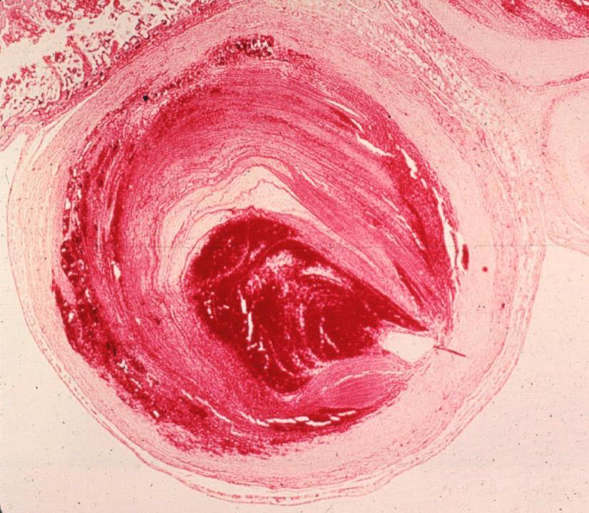 THROMBOSIS Location of thrombi in