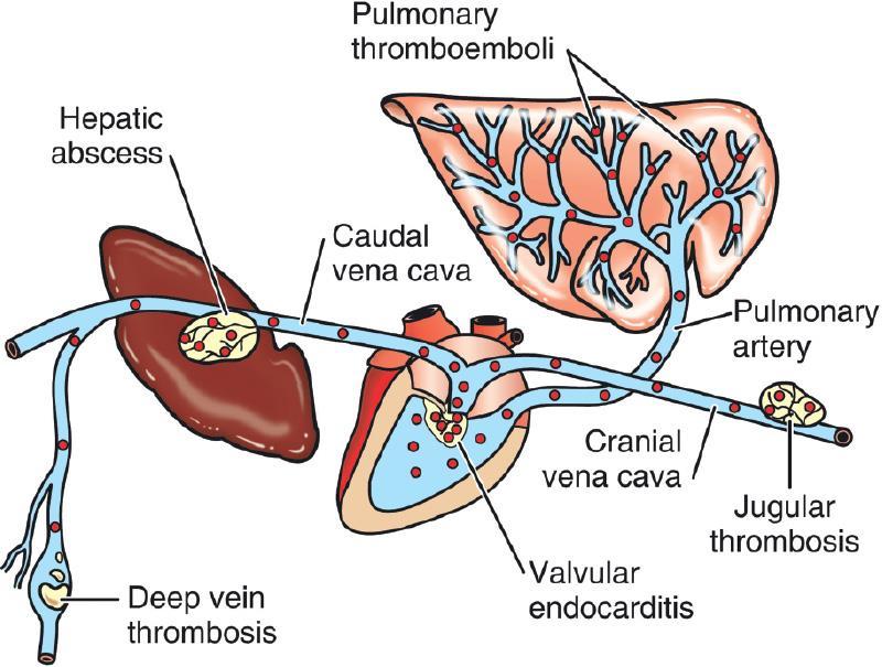 EMBOLISM Thromboembolism
