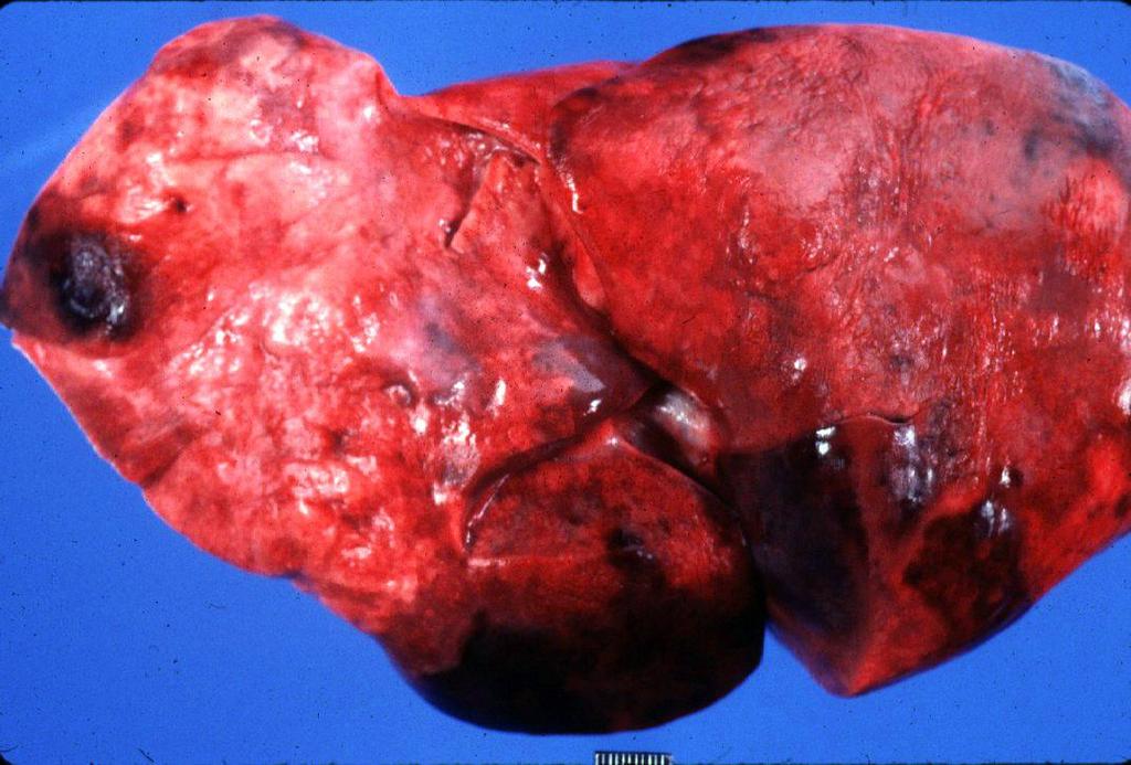 INFARCTION Infarct - Gross appearance Red