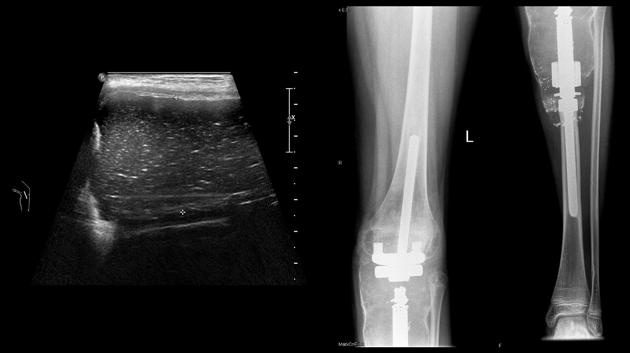 Pol J Radiol, 2017; 82: 227-232 Iwanowska B. et al. Imaging of complications after limb A B Figure 1. 10-year-old boy with osteosarcoma of the tibia one year after implantation of knee prosthesis.