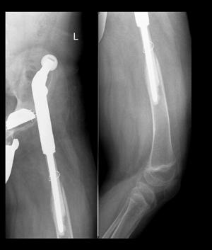 X-ray: fracture of the prosthesis. Figure 6. 19-year-old boy with femoral chondrosarcoma one year after implantation of hip endoprosthesis.