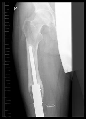16-year-old boy with Ewing s sarcoma one year after implantation of hip endoprosthesis. X-ray: osteolytic area in the medial femoral condyle.