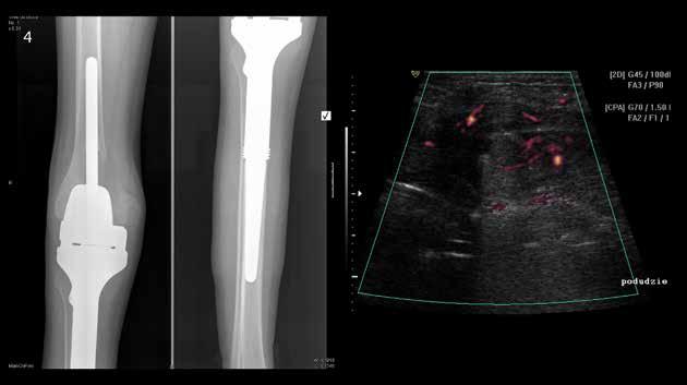 Pol J Radiol, 2017; 82: 227-232 Iwanowska B. et al. Imaging of complications after limb A B Figure 8. 15-year-old boy with tibial osteosarcoma one year after implantation of prosthesis.