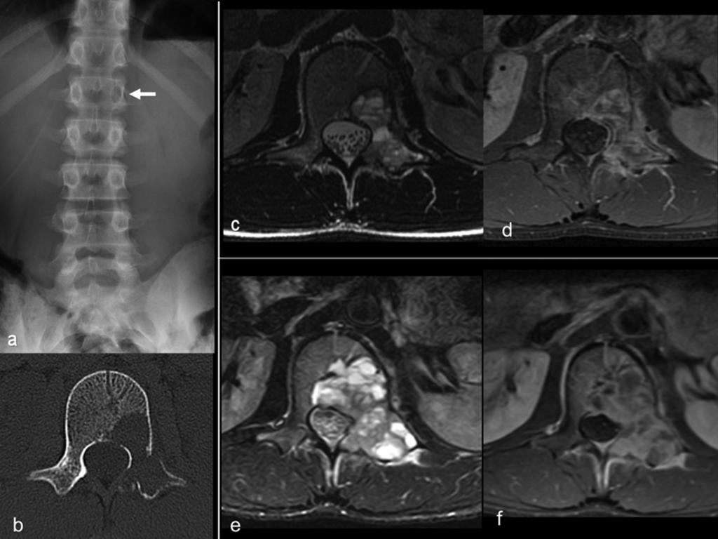 Fig. 5: Aneurysmal bone cyst. 13 year old boy with a history of several months of back pain. The AP spine plain film (a) shows a subtle thinning of the cortex of the left pedicle of L5 (arrow).