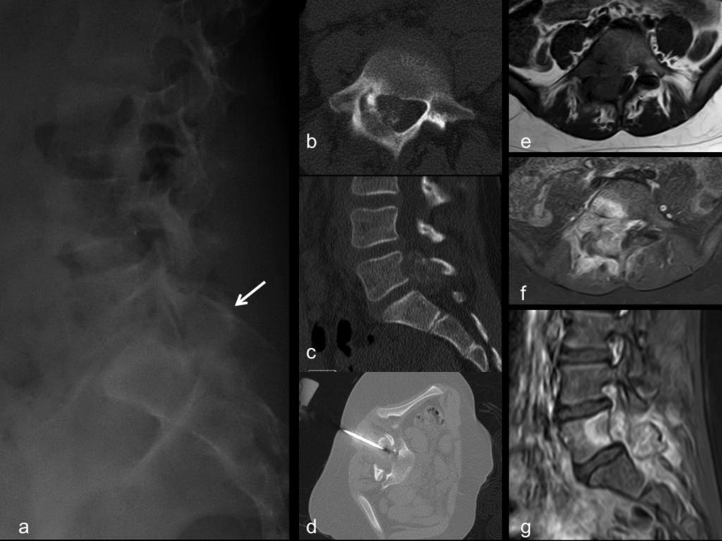 Fig. 6: Osteosarcoma. 9 year old girl with a history of lumbar pain and right sciatica. Lateral plain film of the lumbar spine (a): lytic lesion in the posterior elements of L5 (arrow).