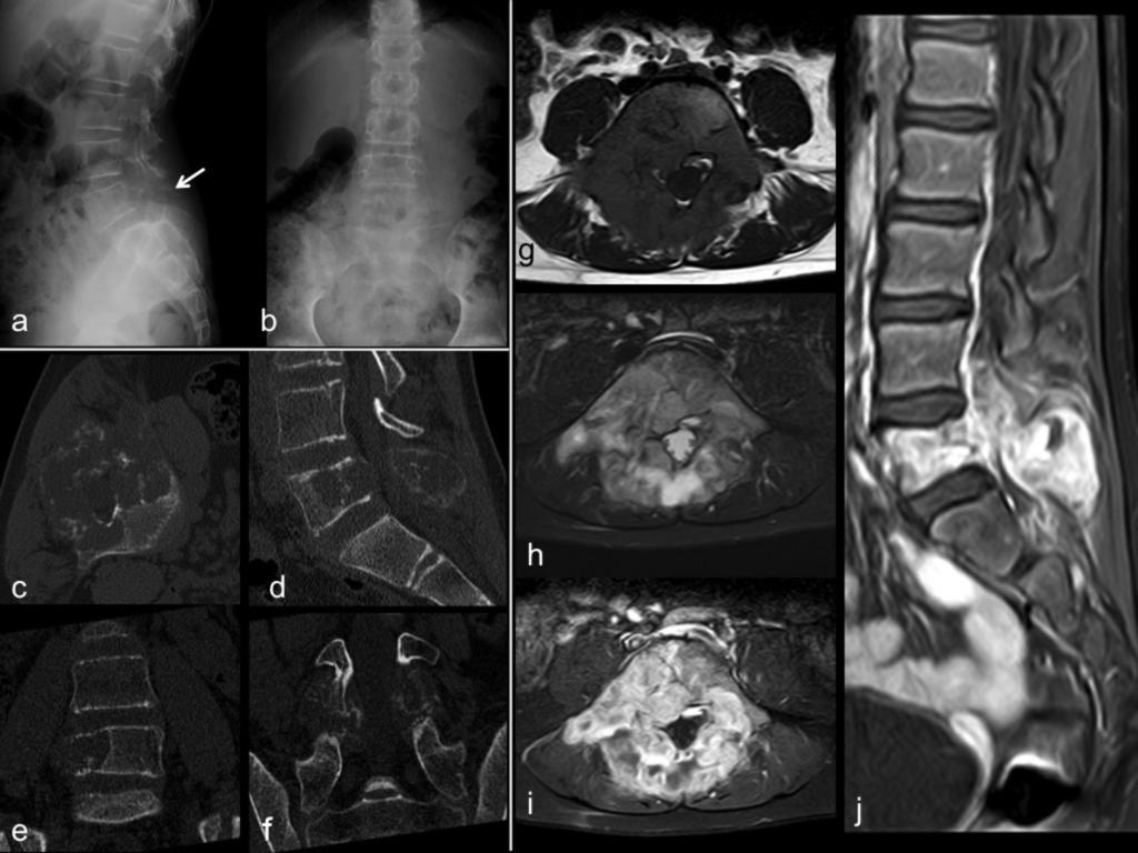 Fig. 7: Osteosarcoma. 11 year old girl with a hisory of three months of back pain.
