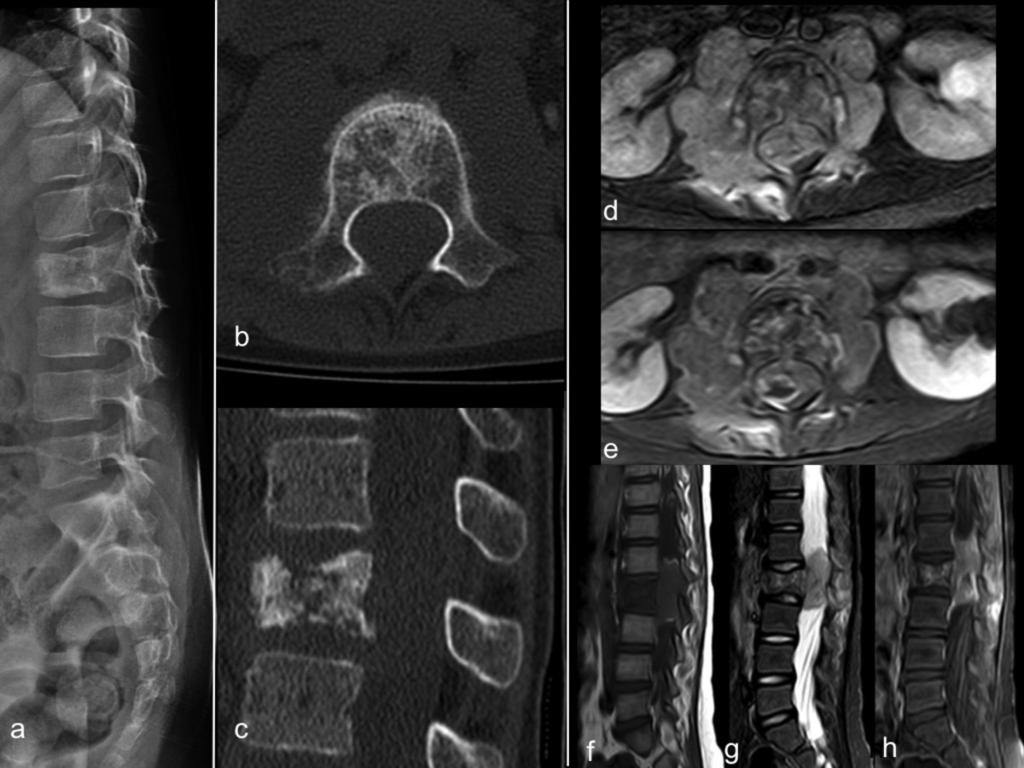 Fig. 9: Ewing sarcoma. 8 year old boy. 3 months of lumbar pain and one month of right leg pain. Lateral spine plain film (a): sclerosis and slight loss of height in the body of L2.