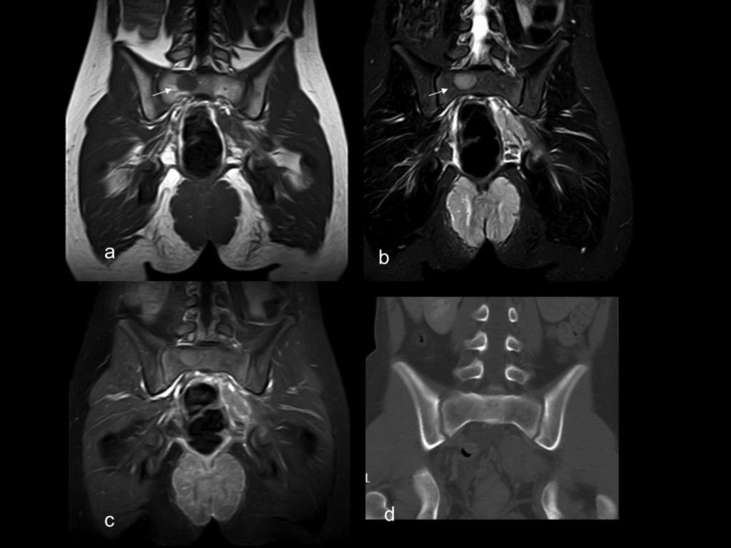 Fig. 11: Metastases of rhabdomyosarcoma. 11 year old with a known history of neurofibromatoses type 1. Arrives at the ER with perianal pain and constipation.