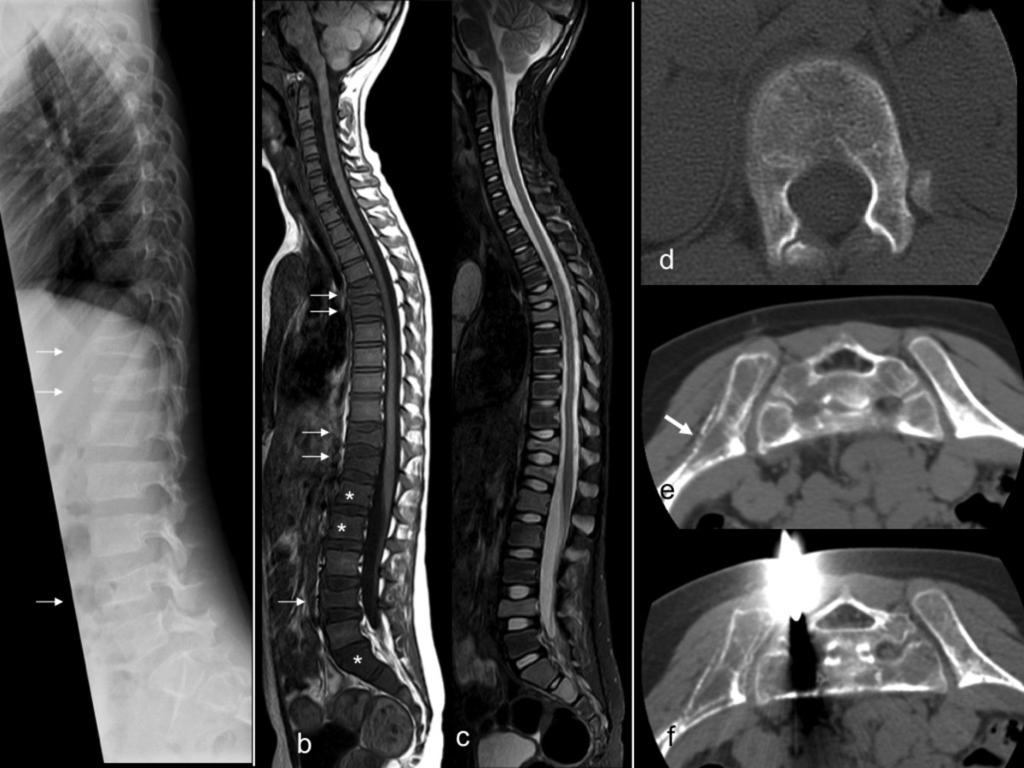 Fig. 12: Leukemia. 9 year old boy with one month history of dorso-lumbar pain, anorexia and loss of weight. Lateral spine plain film (a): Several vertebral spine compression fractures (arrows).