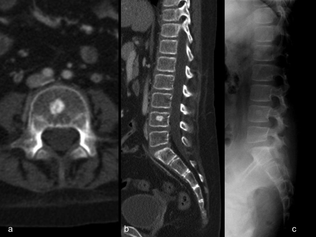 Fig. 1: Bone island. 8 year old girl with acute lymphoblastic leukemia and bone marrow transplantation. Abdominal CT was performed because of acute abdominal pain.