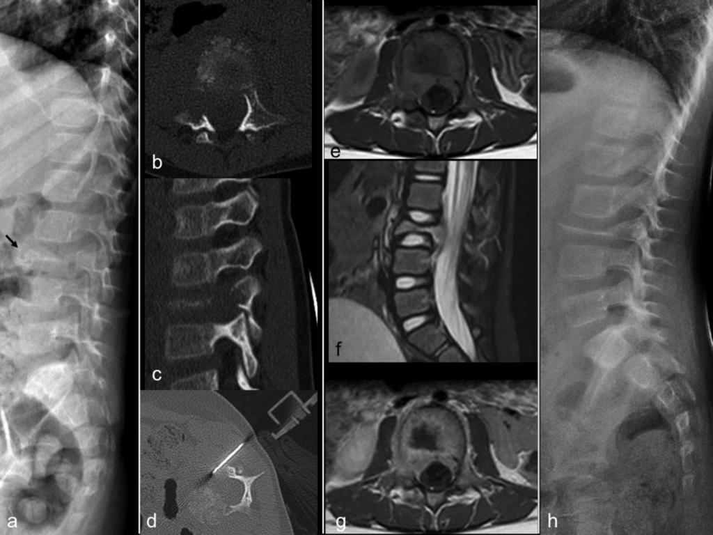 Fig. 2: Langerhans cell histiocitosis. Back pain in a three year old girl. Lateral spine plain film (a): compression fracture in the body of L3.