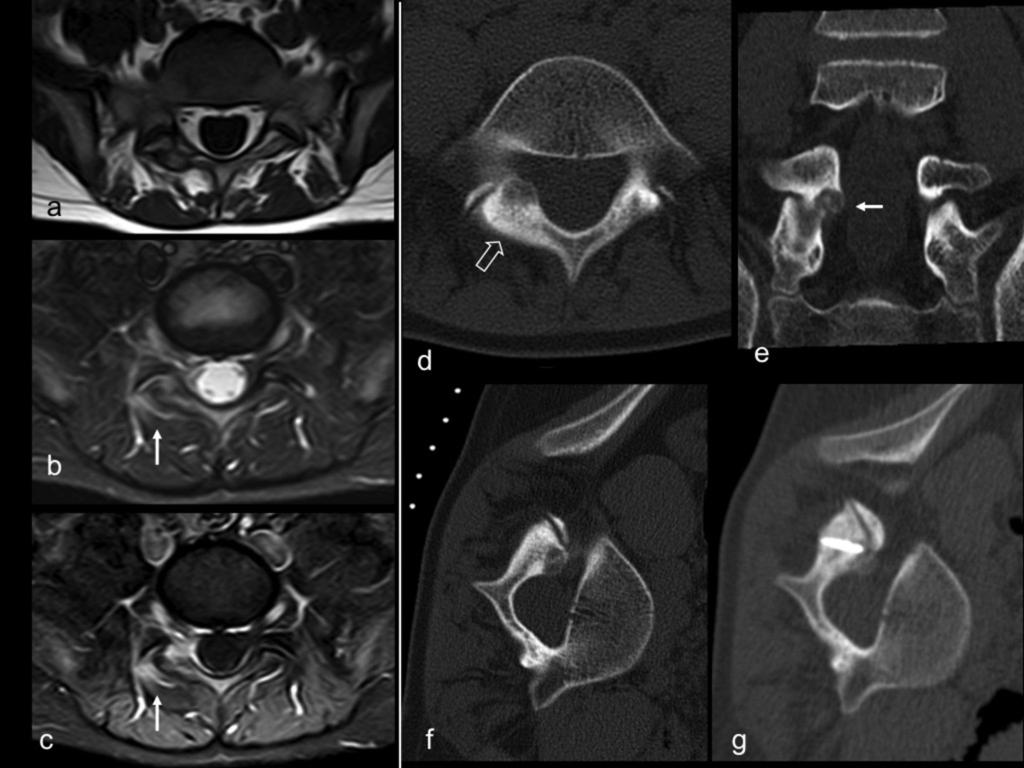 Fig. 3: Osteoid osteoma. 13 year old boy with a 2 years history of sacroiliac related pain.