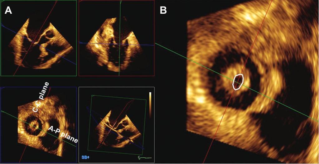 3D Echo in mitral stenosis for Diagnostic accuracy Discrepancy between mitral valve areas measured by 2D